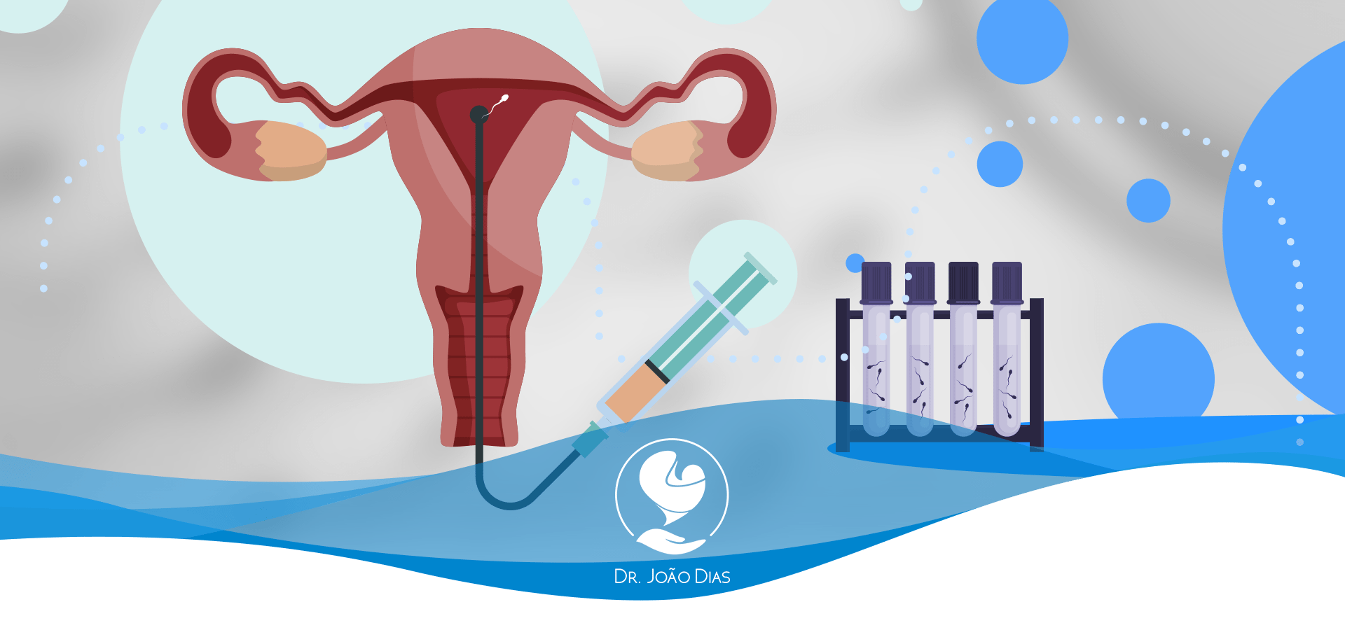 Inseminação intrauterina: qual a taxa de sucesso da técnica?