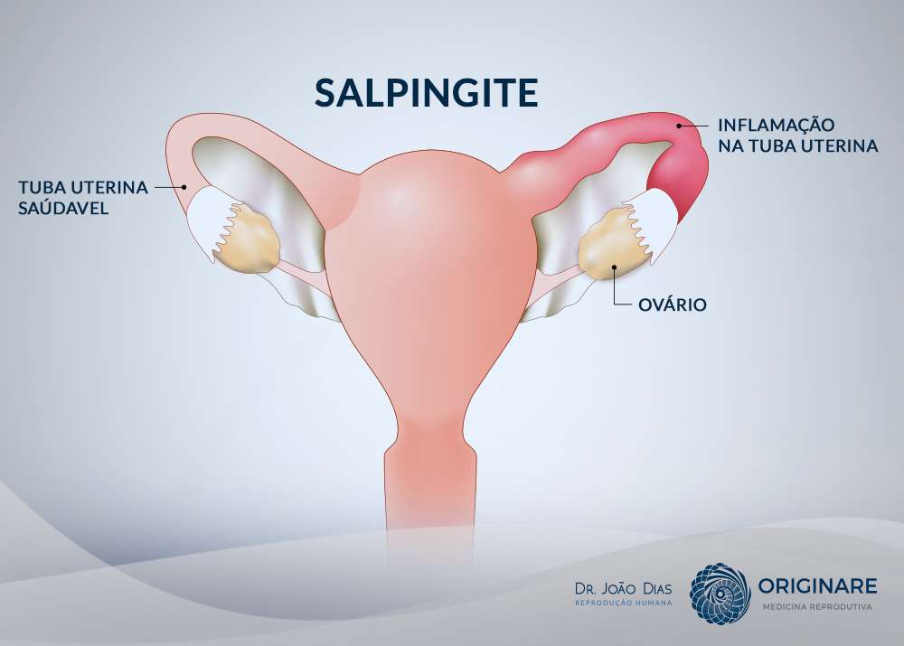 Ooforite - Saiba tudo sobre Ooforite