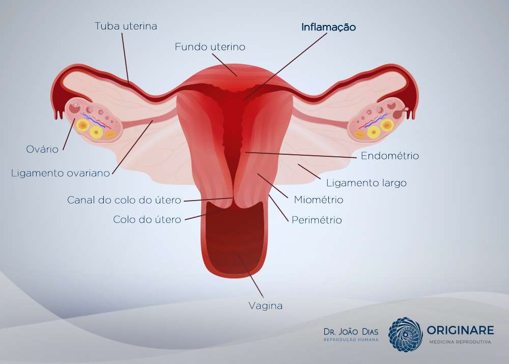 Endometrite e falha de implantação: existe relação?